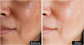 Chemical Peel - Before and After