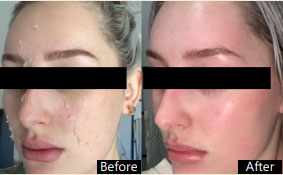 Chemical Peel - Before and After