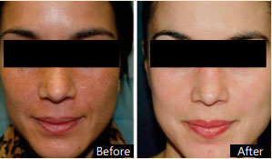 Chemical Peel - Before and After