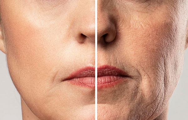 microneedling for acne scars